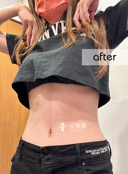 Tainan Abdominal Tightening Treatment Sharing | Double Doctors Team Up for Greater Peace of Mind, Postpartum Body Shape Reversal to Say Goodbye to Sagging Belly